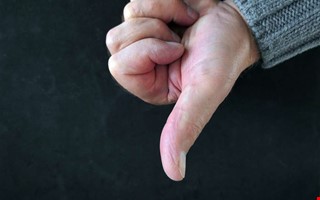 Stelopererad tumme efter v�rdmiss � ingen �tg�rd